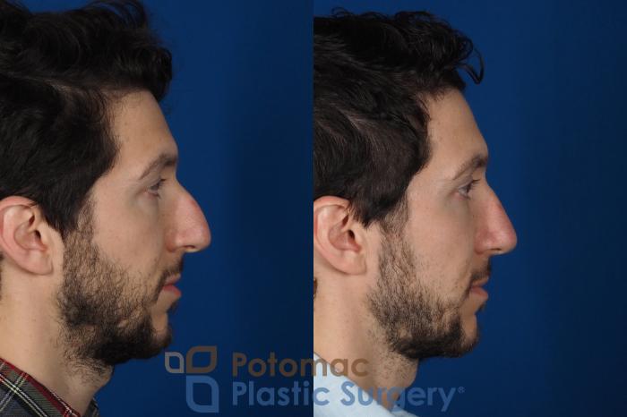 Before & After Rhinoplasty - Medical Case 303 Right Side View in Washington DC & Arlington , DC