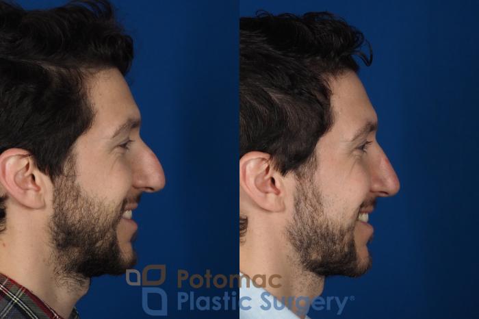 Before & After Rhinoplasty - Cosmetic Case 303 Right - Smiling View in Washington DC & Arlington , DC