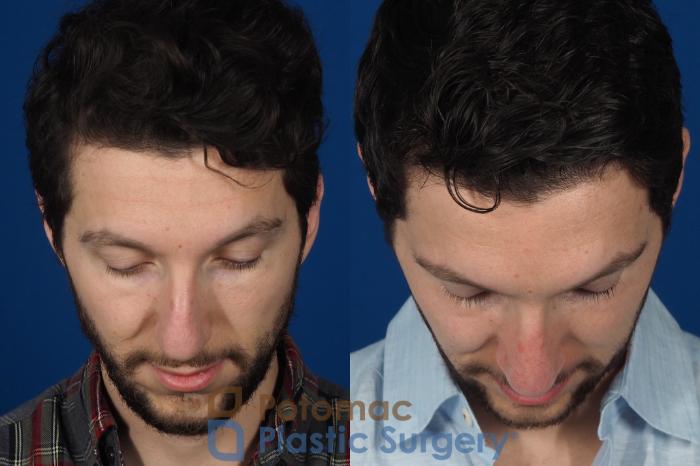 Before & After Rhinoplasty - Medical Case 303 Top View in Washington DC & Arlington , DC