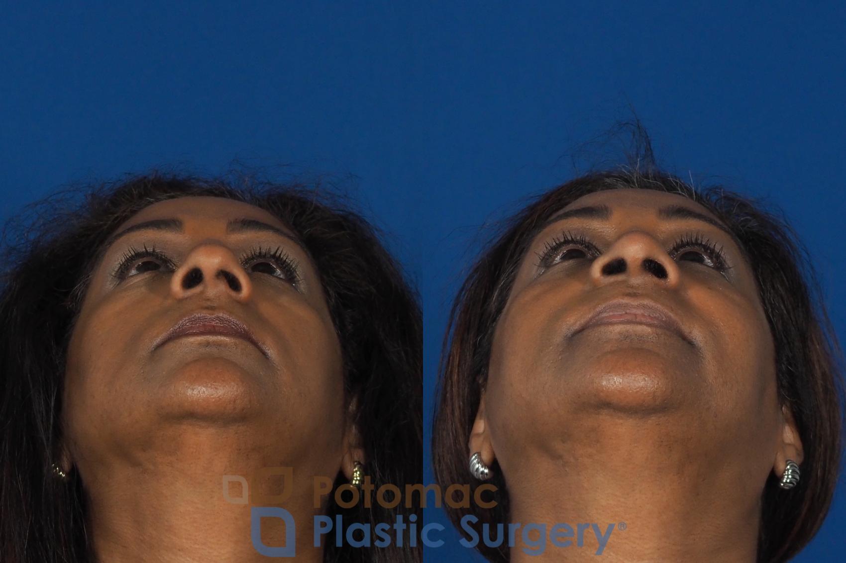 Before & After Rhinoplasty - Cosmetic Case 307 Bottom View in Washington DC & Arlington , DC