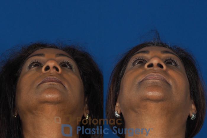 Before & After Rhinoplasty - Cosmetic Case 307 Bottom View in Washington DC & Arlington , DC