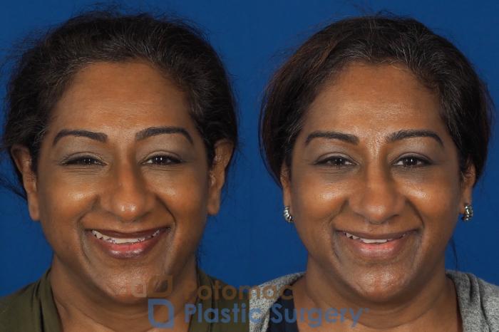 Before & After Rhinoplasty - Cosmetic Case 307 Front - Smiling View in Washington DC & Arlington , DC