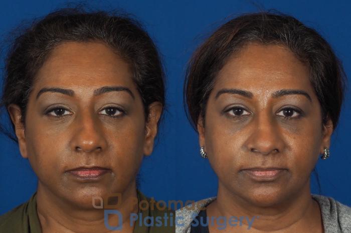 Before & After Rhinoplasty - Cosmetic Case 307 Front View in Washington DC & Arlington , DC