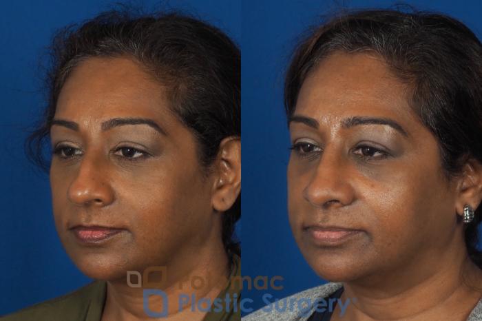 Before & After Rhinoplasty - Cosmetic Case 307 Left Oblique View in Washington DC & Arlington , DC