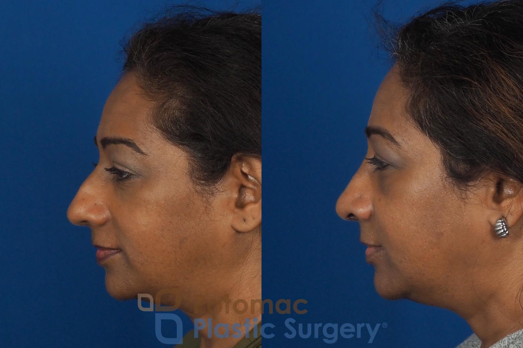 Before & After Rhinoplasty - Cosmetic Case 307 Left Side View in Washington DC & Arlington , DC