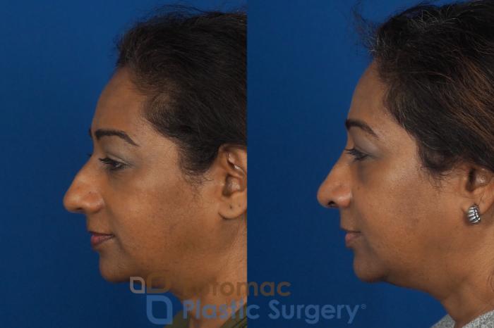 Before & After Rhinoplasty - Cosmetic Case 307 Left Side View in Washington DC & Arlington , DC
