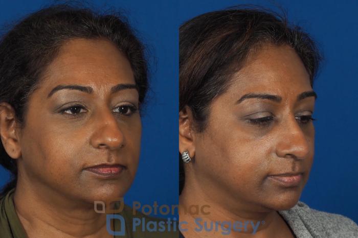 Before & After Rhinoplasty - Cosmetic Case 307 Right Oblique View in Washington DC & Arlington , DC