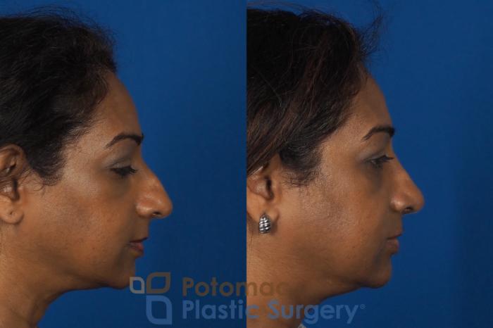 Before & After Rhinoplasty - Cosmetic Case 307 Right Side View in Washington DC & Arlington , DC