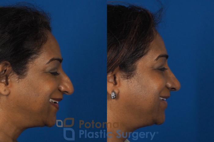 Before & After Rhinoplasty - Cosmetic Case 307 Right - Smiling View in Washington DC & Arlington , DC