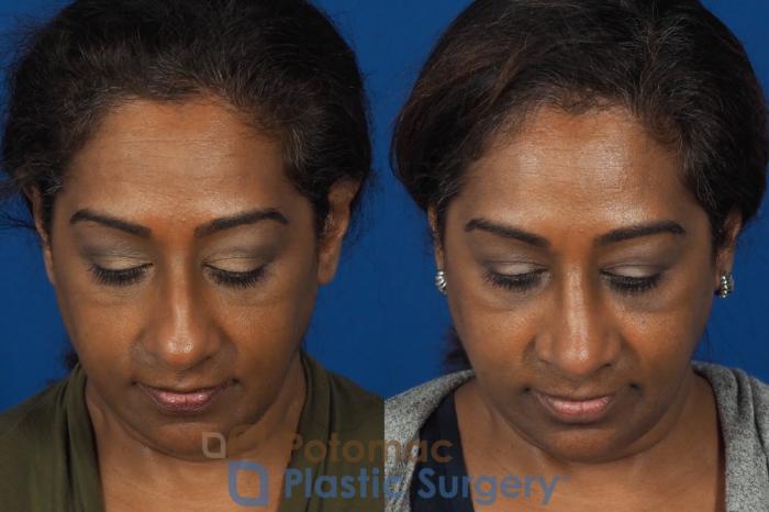 Before & After Rhinoplasty - Cosmetic Case 307 Top View in Washington DC & Arlington , DC