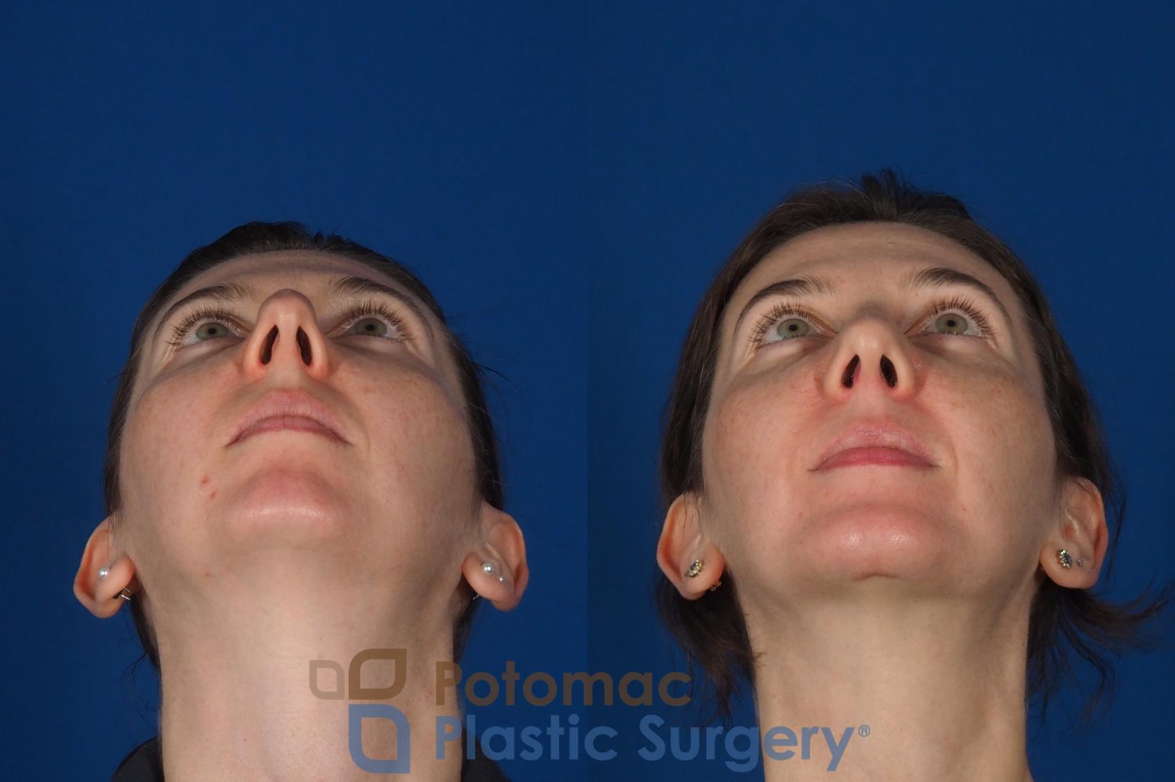 Before & After Chin Augmentation Case 309 Bottom View in Washington DC & Arlington , DC