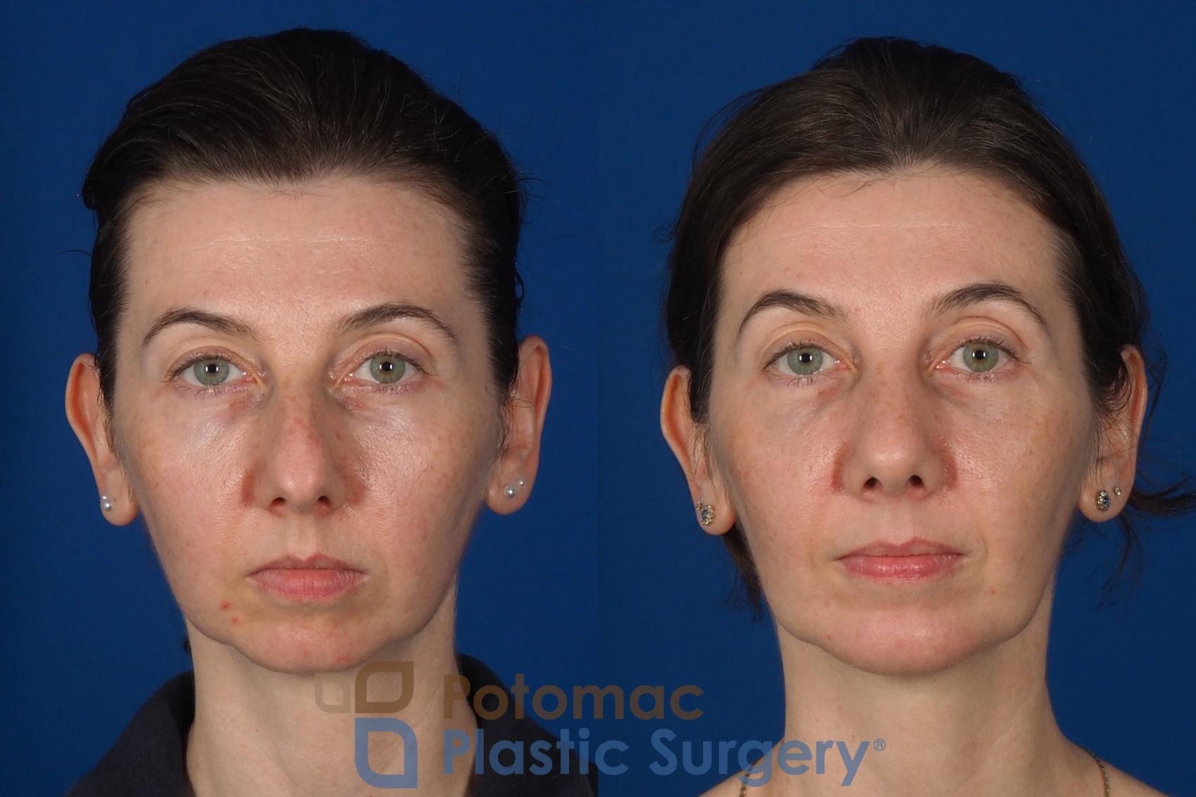 Before & After Rhinoplasty - Cosmetic Case 309 Front View in Washington DC & Arlington , DC