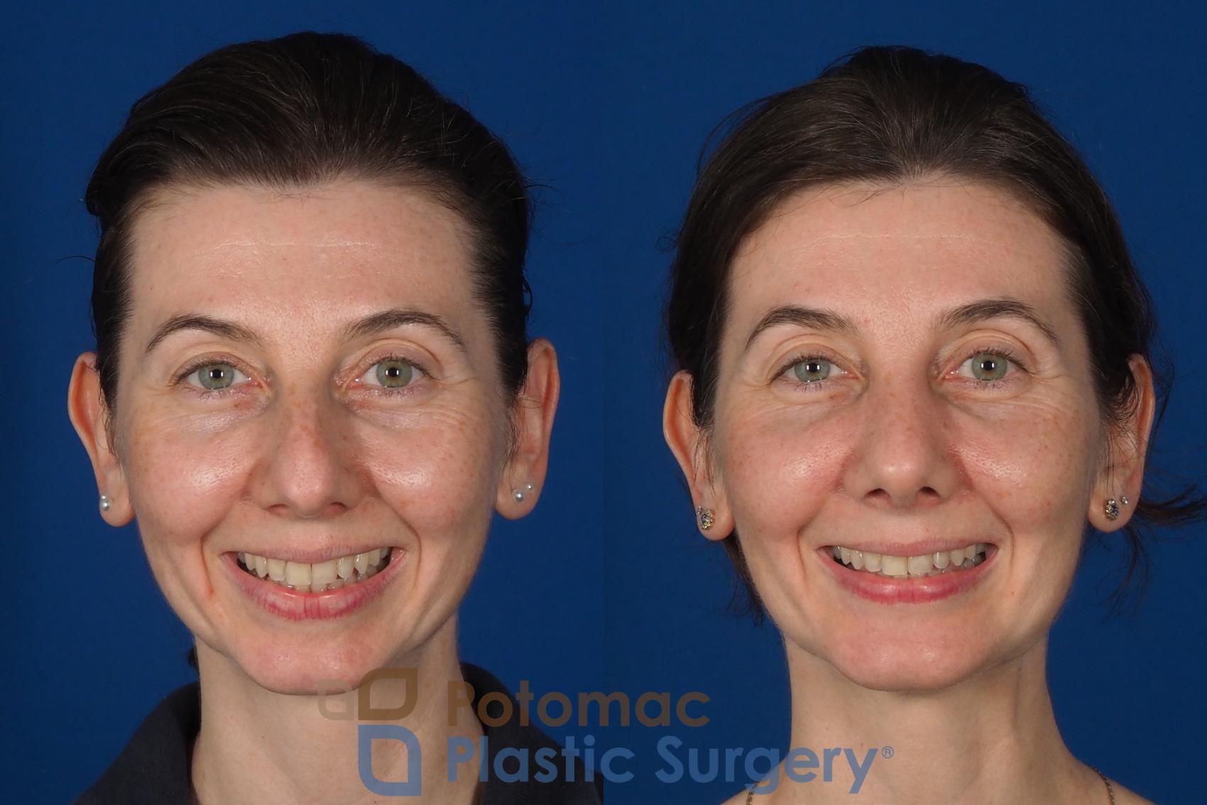Before & After Chin Augmentation Case 309 Front - Smiling View in Washington DC & Arlington , DC
