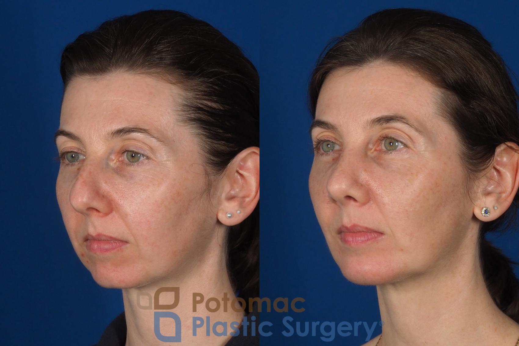 Before & After Chin Augmentation Case 309 Left Oblique View in Washington DC & Arlington , DC