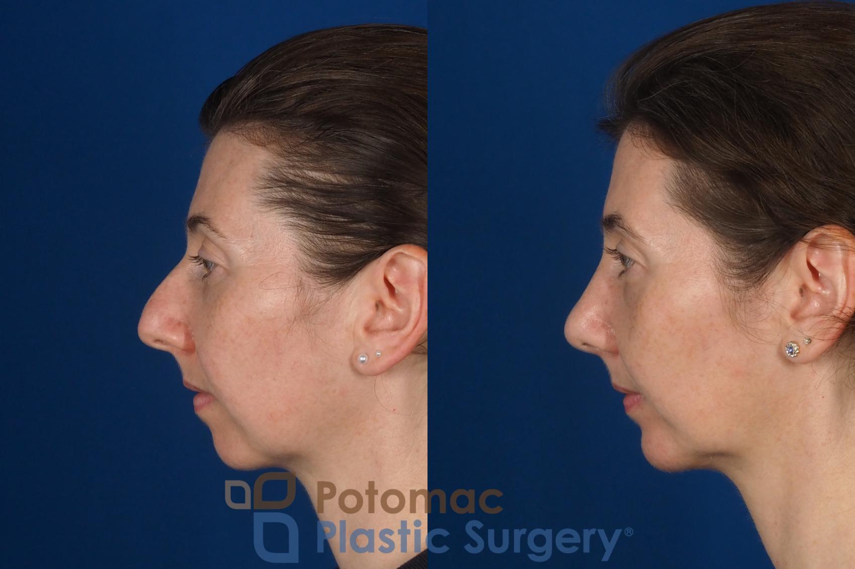 Before & After Chin Augmentation Case 309 Left Side View in Washington DC & Arlington , DC