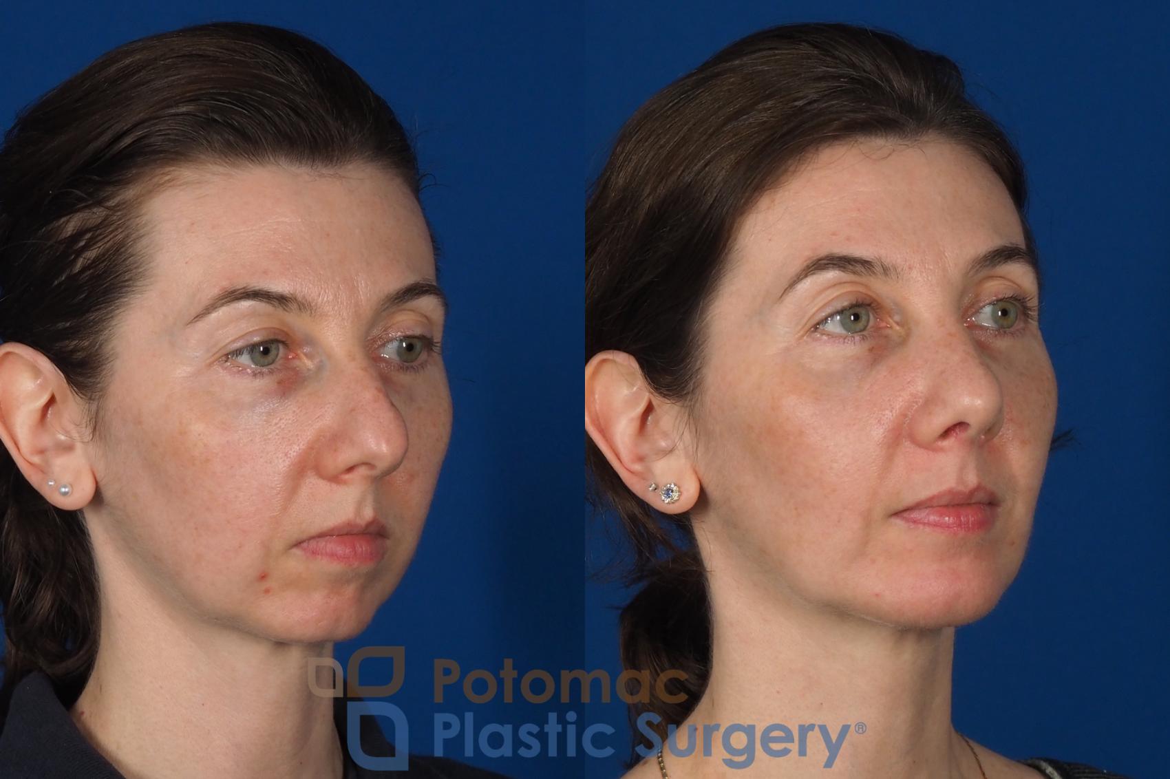 Before & After Chin Augmentation Case 309 Right Oblique View in Washington DC & Arlington , DC
