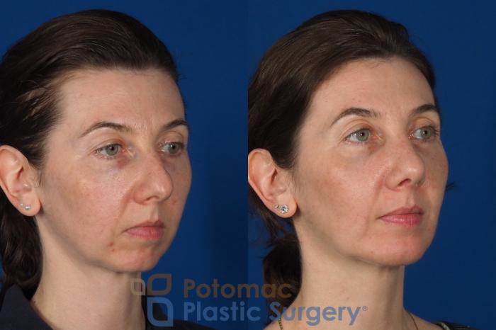 Before & After Rhinoplasty - Cosmetic Case 309 Right Oblique View in Washington DC & Arlington , DC