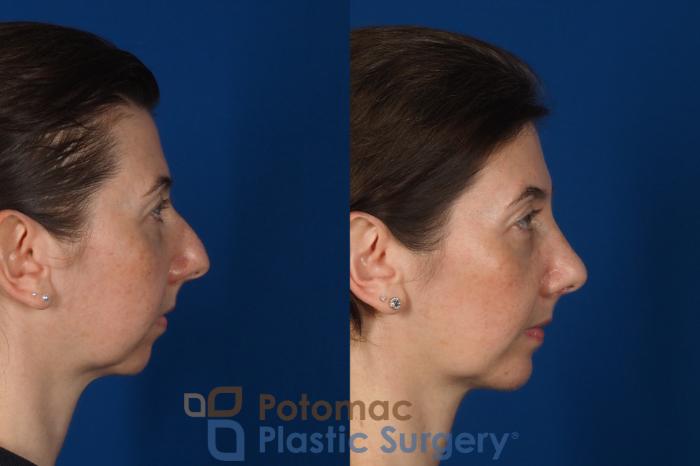 Before & After Rhinoplasty - Cosmetic Case 309 Right Side View in Washington DC & Arlington , DC