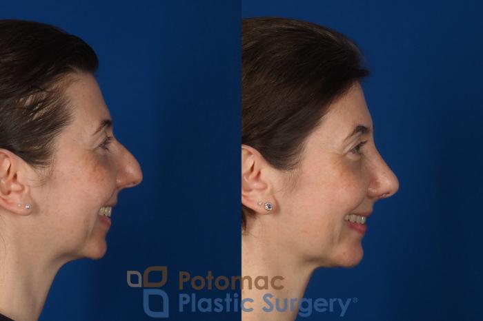 Before & After Rhinoplasty - Cosmetic Case 309 Right - Smiling View in Washington DC & Arlington , DC