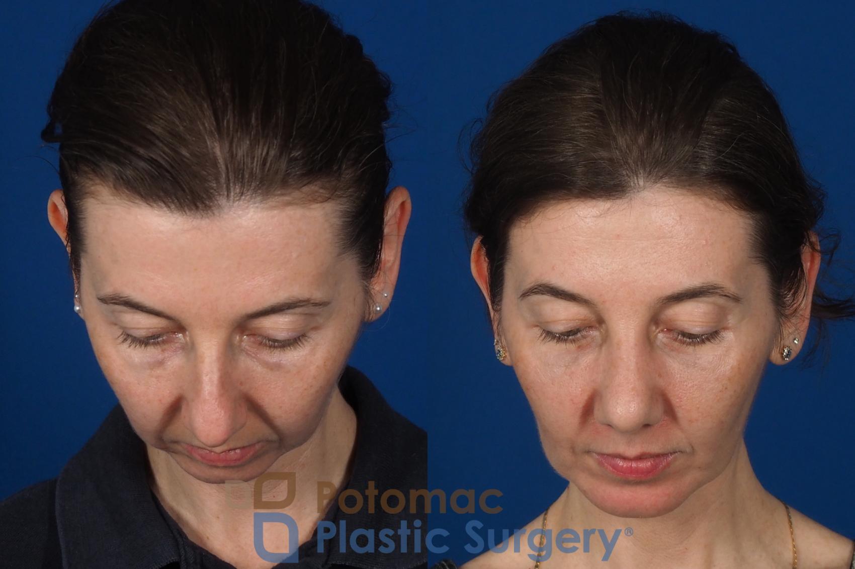 Before & After Chin Augmentation Case 309 Top View in Washington DC & Arlington , DC
