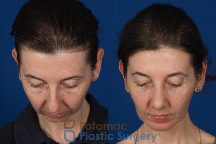 Before & After Rhinoplasty - Cosmetic Case 309 Top View in Washington DC & Arlington , DC