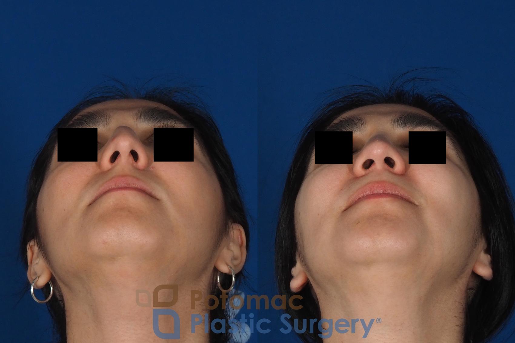 Before & After Rhinoplasty - Cosmetic Case 310 Bottom View in Washington DC & Arlington , DC