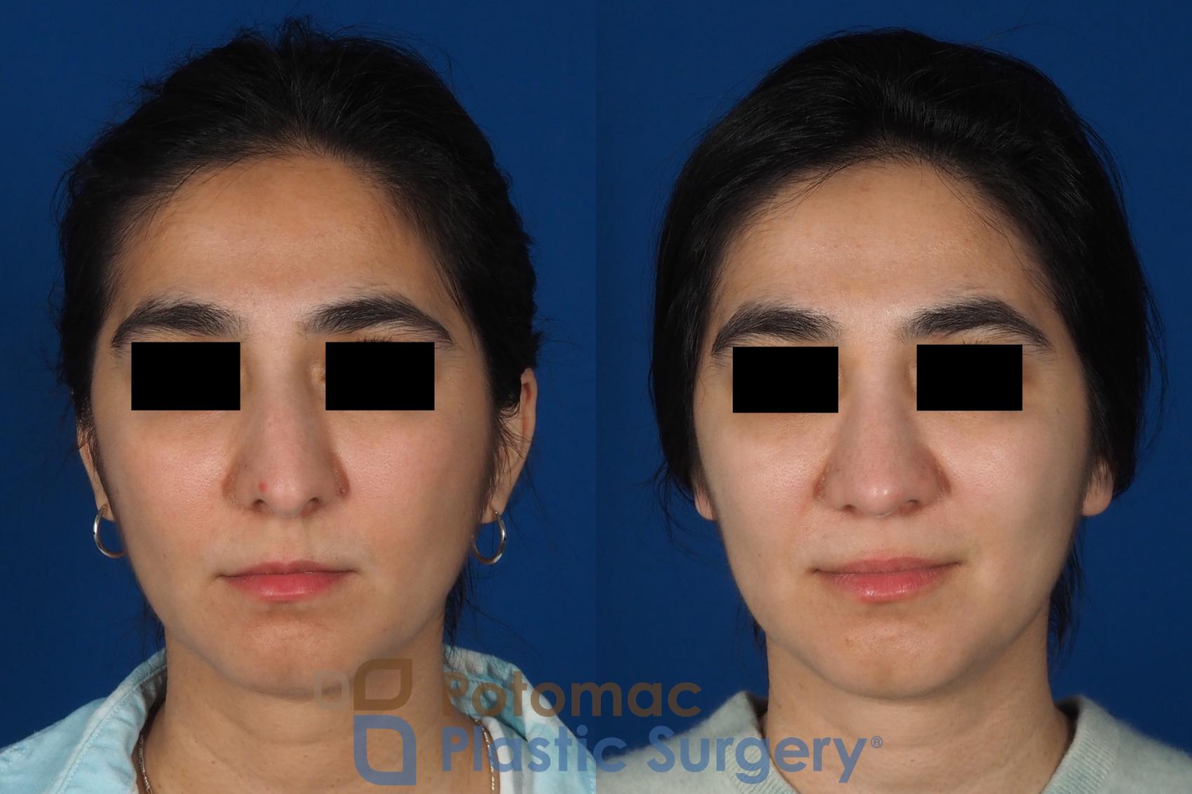 Before & After Rhinoplasty - Cosmetic Case 310 Front View in Washington, DC