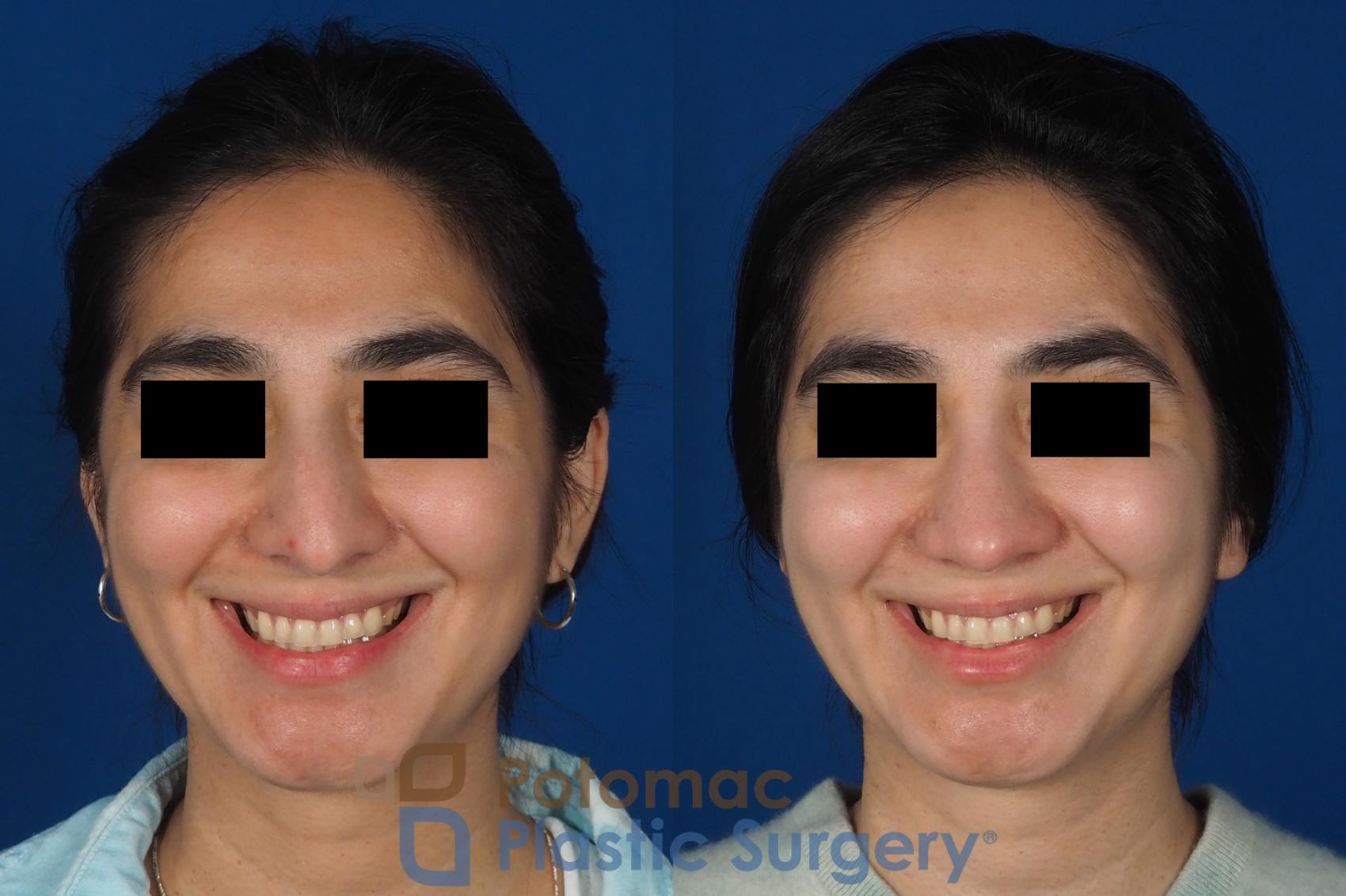 Before & After Rhinoplasty - Cosmetic Case 310 Front - Smiling View in Washington DC & Arlington , DC