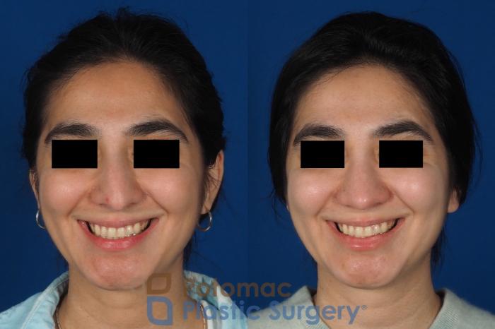 Before & After Rhinoplasty - Cosmetic Case 310 Front - Smiling View in Washington, DC