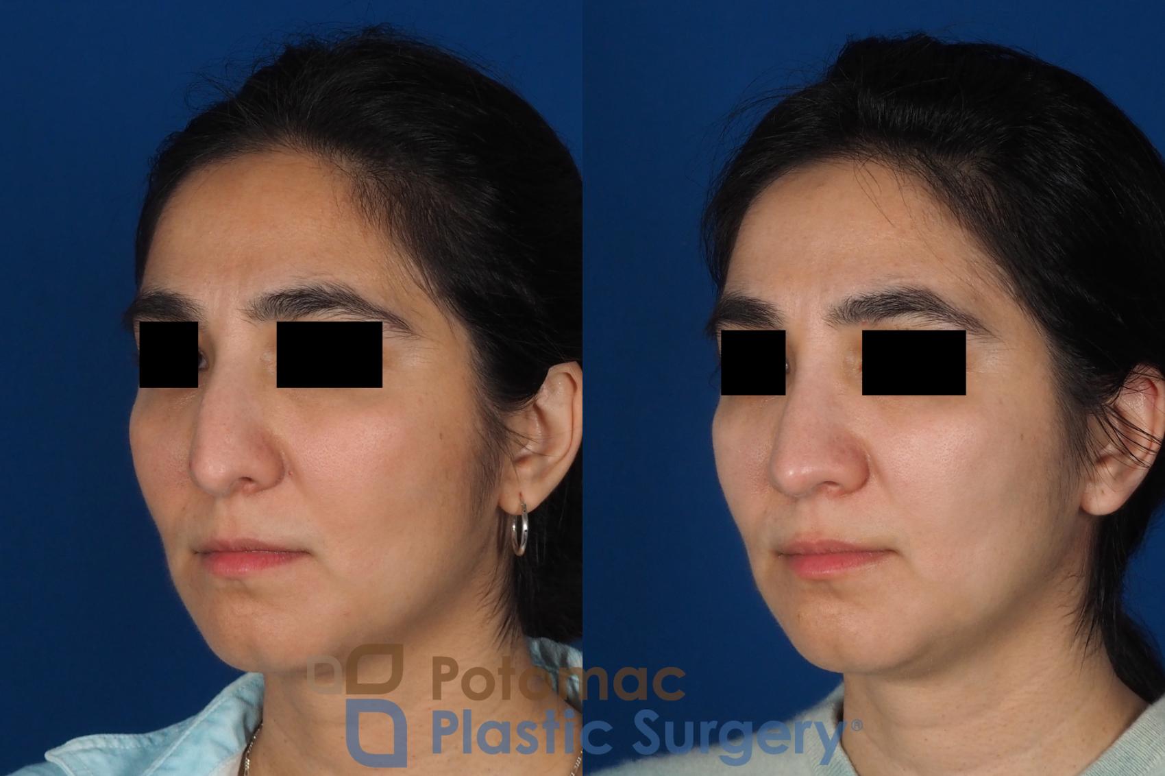 Before & After Rhinoplasty - Cosmetic Case 310 Left Oblique View in Washington DC & Arlington , DC