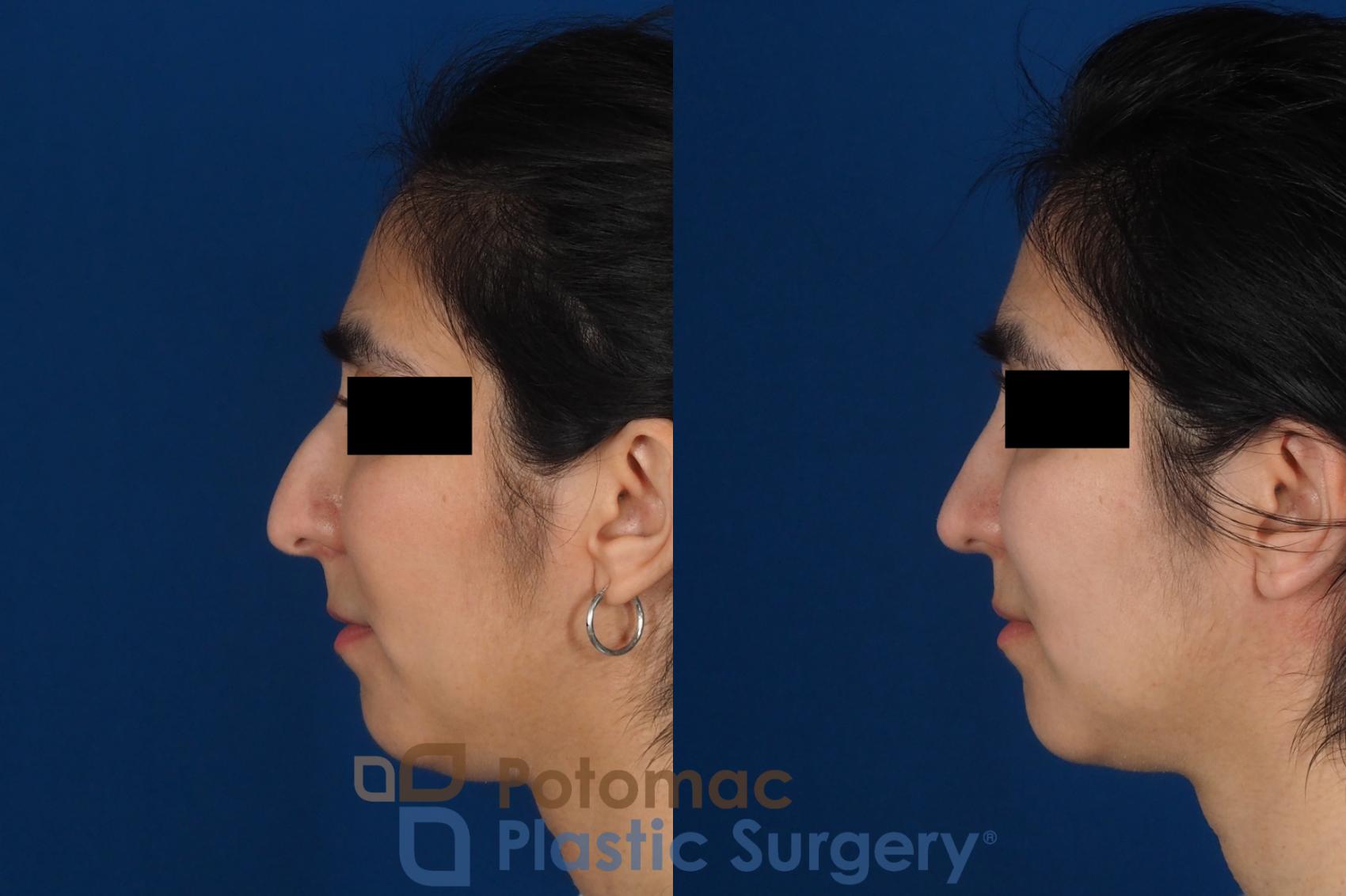 Before & After Rhinoplasty - Cosmetic Case 310 Left Side View in Washington DC & Arlington , DC