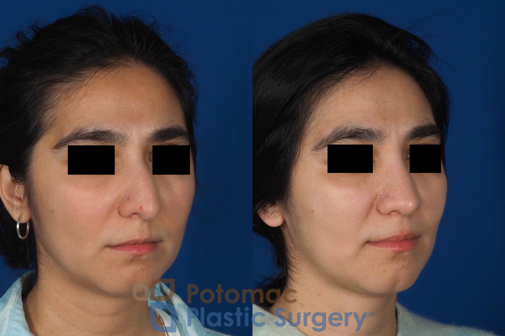 Before & After Rhinoplasty - Cosmetic Case 310 Right Oblique View in Washington DC & Arlington , DC
