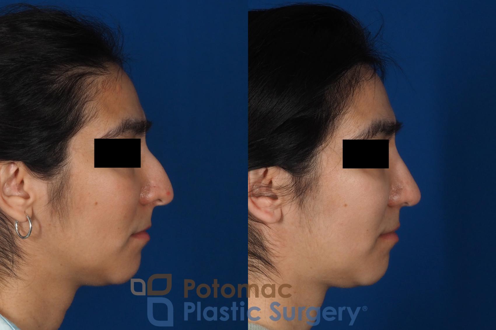 Before & After Rhinoplasty - Cosmetic Case 310 Right Side View in Washington DC & Arlington , DC