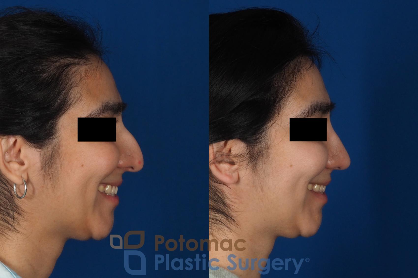 Before & After Rhinoplasty - Cosmetic Case 310 Right - Smiling View in Washington DC & Arlington , DC