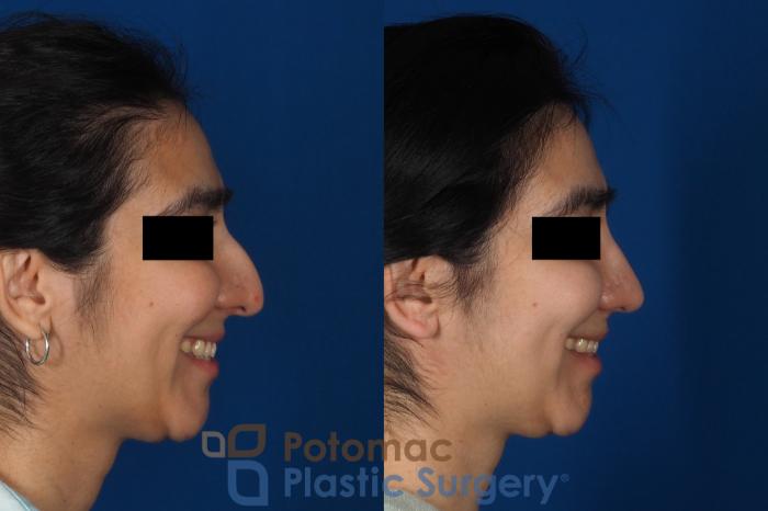Before & After Rhinoplasty - Cosmetic Case 310 Right - Smiling View in Washington, DC
