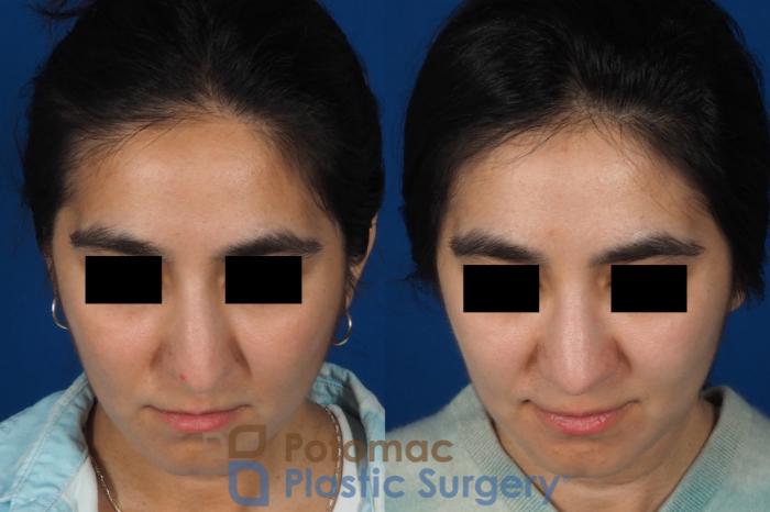 Before & After Rhinoplasty - Cosmetic Case 310 Top View in Washington, DC