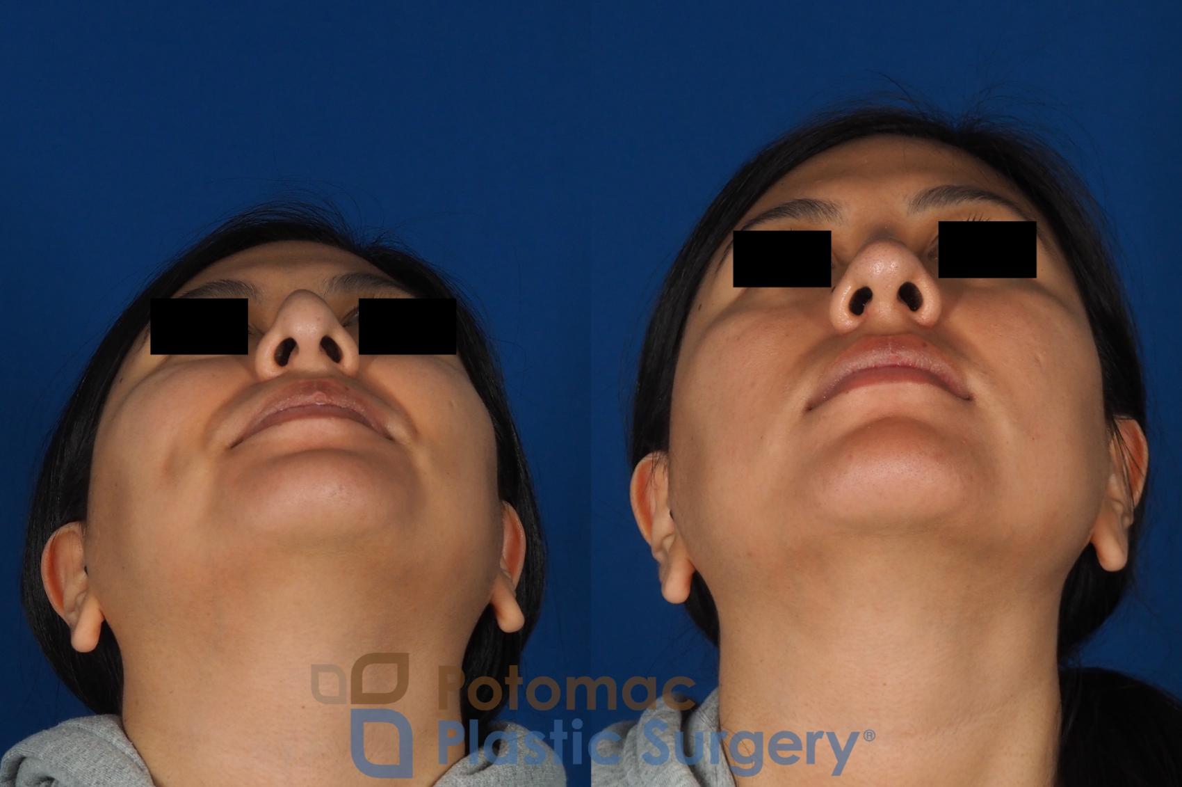 Before & After Rhinoplasty - Cosmetic Case 314 Bottom View in Washington DC & Arlington , DC