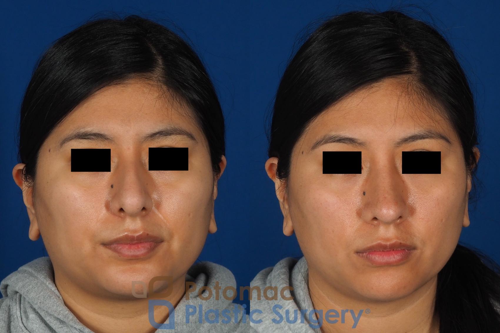 Before & After Rhinoplasty - Cosmetic Case 314 Front View in Washington DC & Arlington , DC