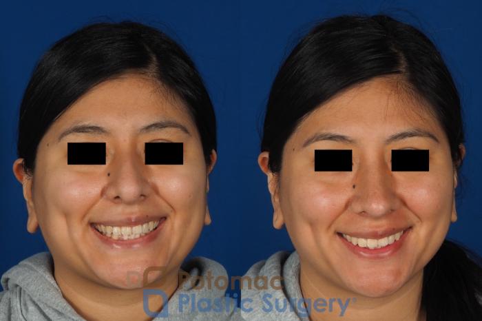 Before & After Rhinoplasty - Cosmetic Case 314 Front - Smiling View in Washington DC & Arlington , DC