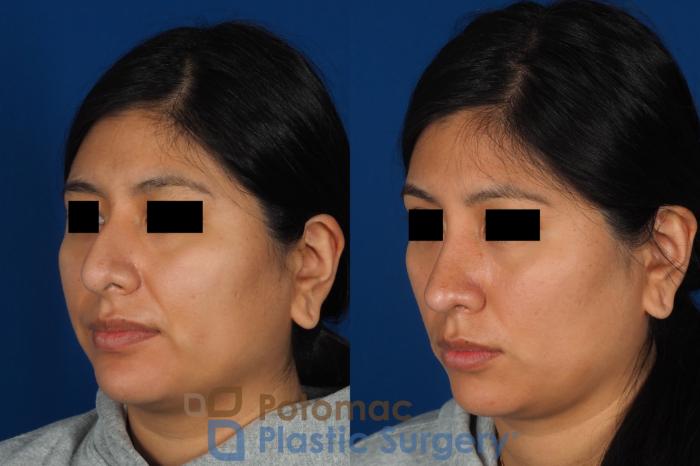 Before & After Rhinoplasty - Cosmetic Case 314 Left Oblique View in Washington DC & Arlington , DC