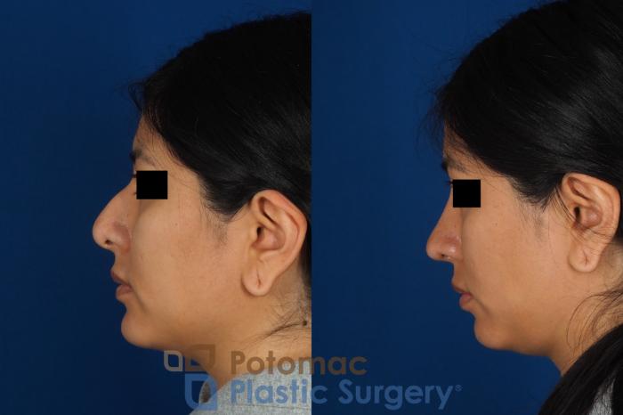 Before & After Rhinoplasty - Cosmetic Case 314 Left Side View in Washington DC & Arlington , DC
