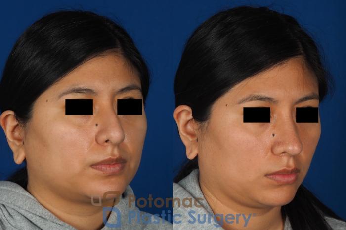 Before & After Rhinoplasty - Cosmetic Case 314 Right Oblique View in Washington DC & Arlington , DC