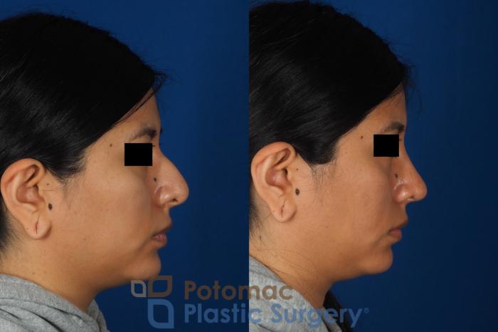 Before & After Rhinoplasty - Cosmetic Case 314 Right Side View in Washington DC & Arlington , DC