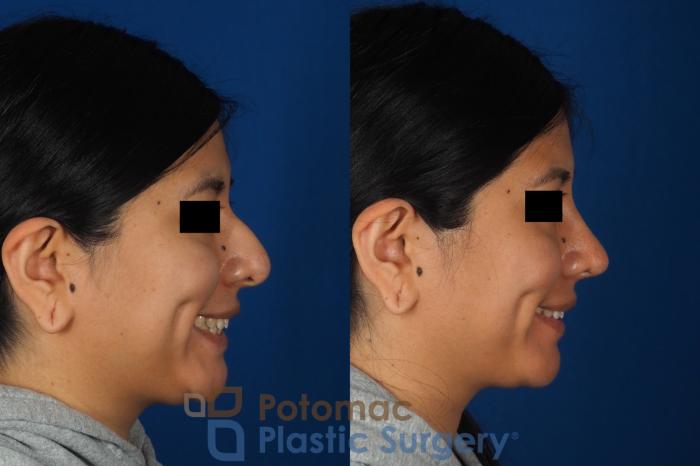 Before & After Rhinoplasty - Cosmetic Case 314 Right - Smiling View in Washington DC & Arlington , DC