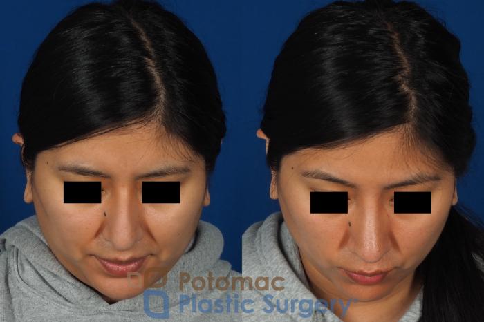 Before & After Rhinoplasty - Cosmetic Case 314 Top View in Washington DC & Arlington , DC