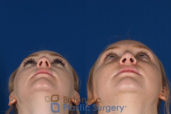 Before & After Rhinoplasty - Cosmetic Case 318 Bottom View in Washington DC & Arlington , DC