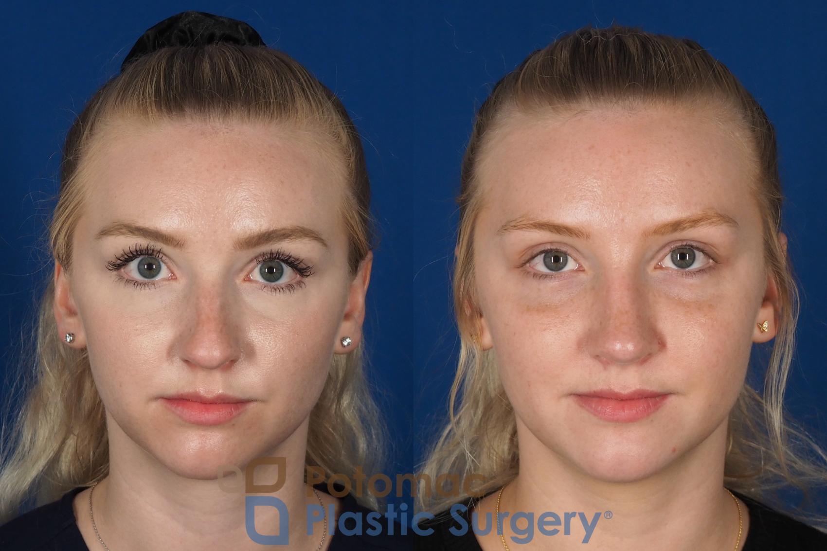 Before & After Rhinoplasty - Cosmetic Case 318 Front View in Washington DC & Arlington , DC