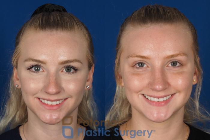 Before & After Rhinoplasty - Cosmetic Case 318 Front - Smiling View in Washington DC & Arlington , DC