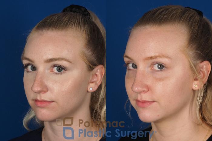 Before & After Rhinoplasty - Cosmetic Case 318 Left Oblique 2 View in Washington DC & Arlington , DC