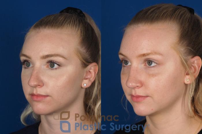 Before & After Rhinoplasty - Cosmetic Case 318 Left Oblique View in Washington DC & Arlington , DC